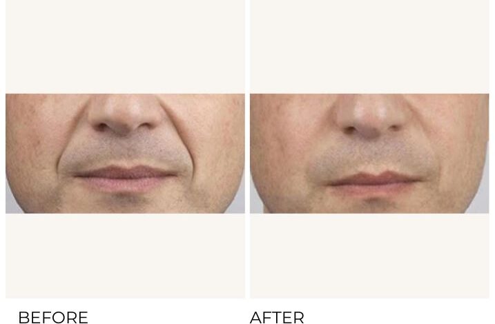 Men are getting filler more than ever