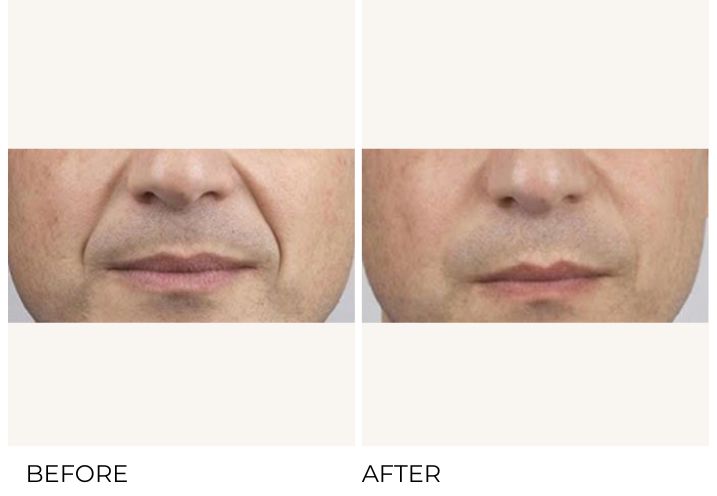 Men are getting filler more than ever