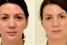 I drank 25 liters of water a day for a week