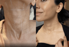How to treat neck wrinkles