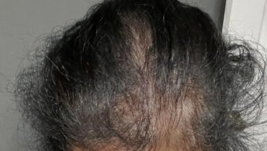 Nara smith rosemary hair growth