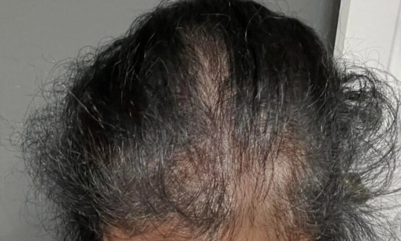 Nara smith rosemary hair growth
